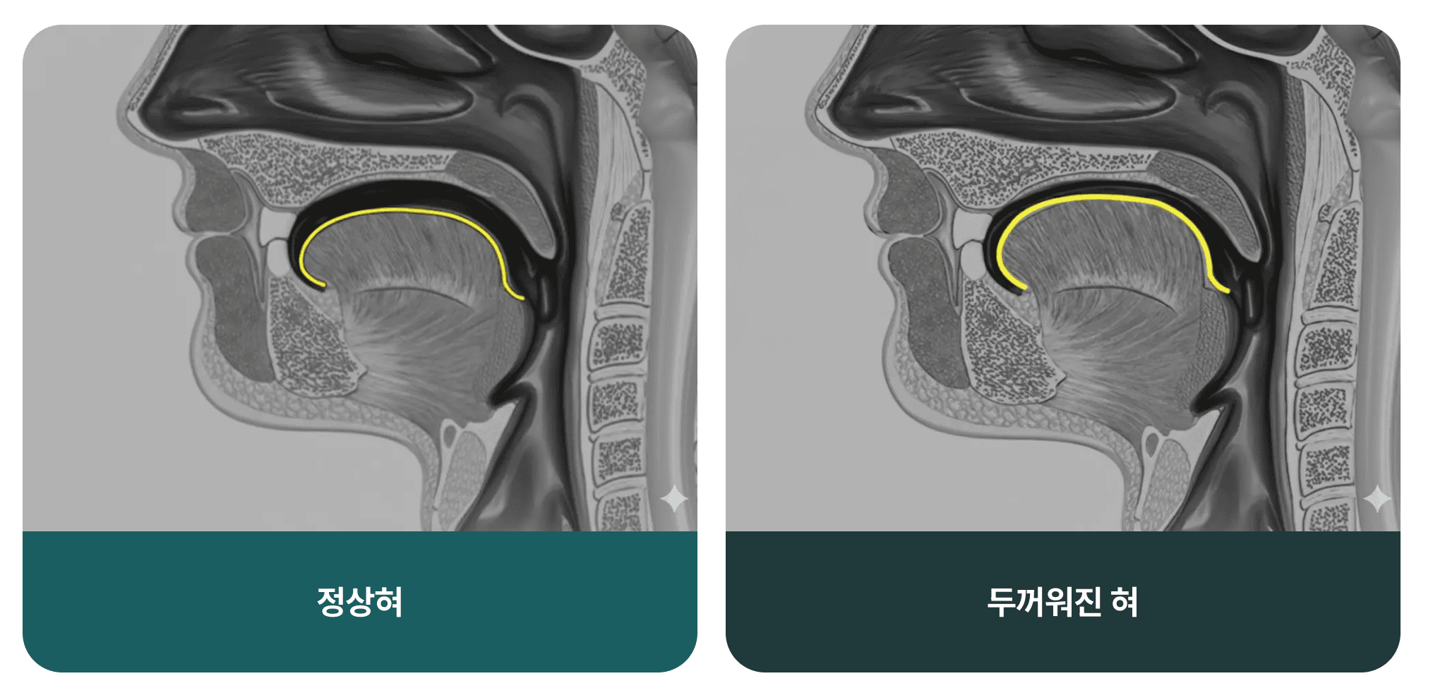 인체 단면도에서 정상 혀와 두꺼워진 혀의 기도 공간 차이를 나타낸다.