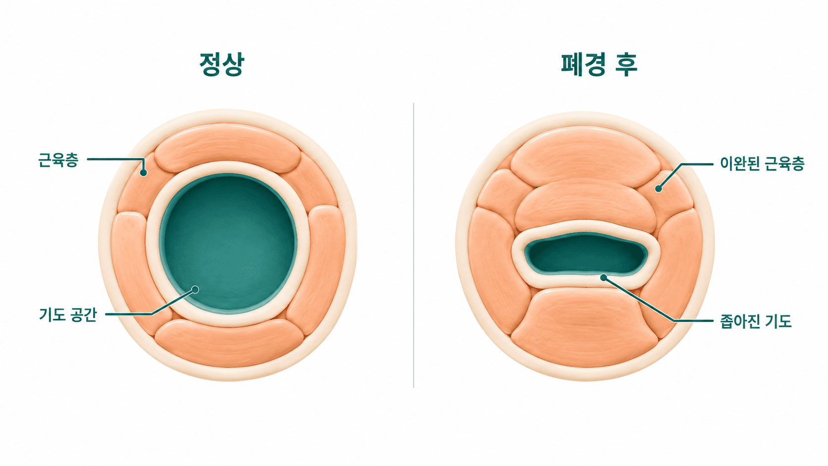 정상 기도는 넓고 폐경 후 기도는 이완된 근육층으로 인해 좁아져 있다.