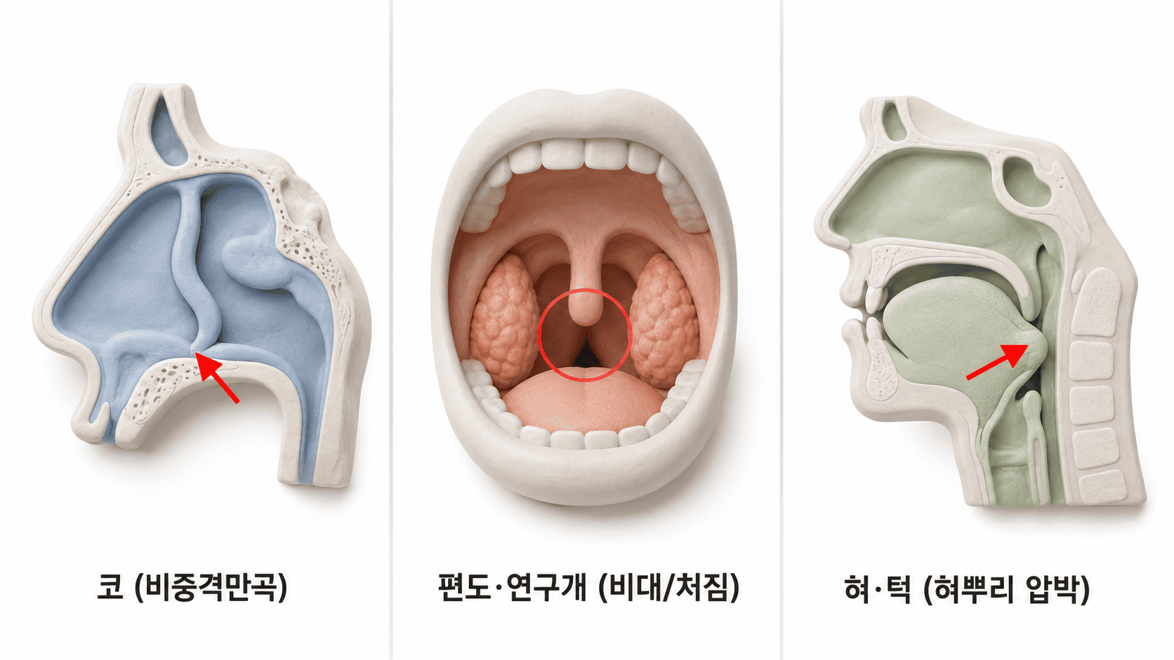수면무호흡증 원인인 코 비중격만곡, 편도 연구개 비대, 혀뿌리 압박을 보여주는 해부 모형.