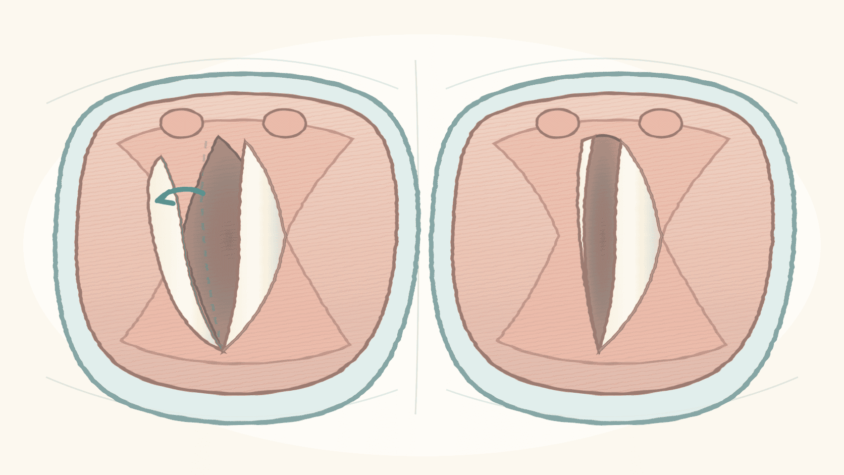 호흡과 발성 때 한쪽 성대가 같은 위치에 머무는 성대마비 2D 의료 일러스트